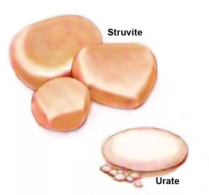 Растворение струвитов. Струвиты оксалаты уролаты. Ураты в моче. Как выглядят струвиты. Ураты камни.