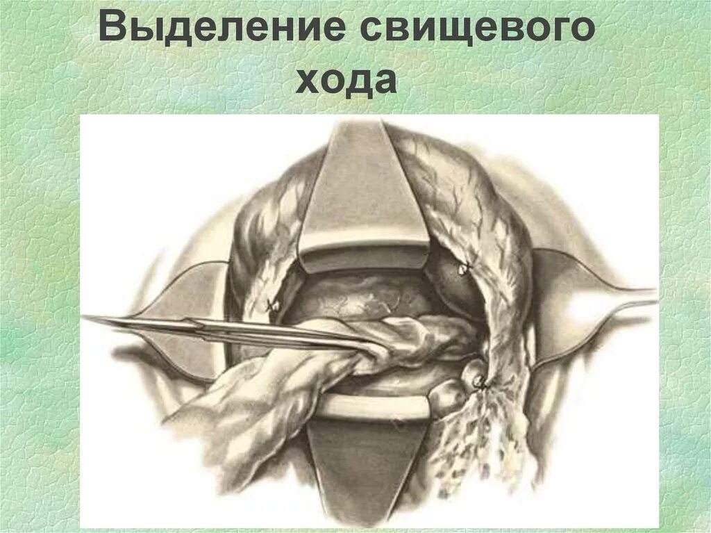 Операция при остром панкреатите. Рассечение кольцевидной связки. Операции при остром панкреатите. Операции при остром панкреатите хирургия.