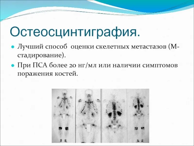 Метастазы в кости при раке предстательной. Остеосцинтиграфия метастазы. Онкология остеосцинтиграфия. Остеосцинтиграфия показания.