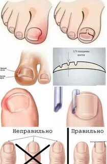 Ноготь растет в кожу