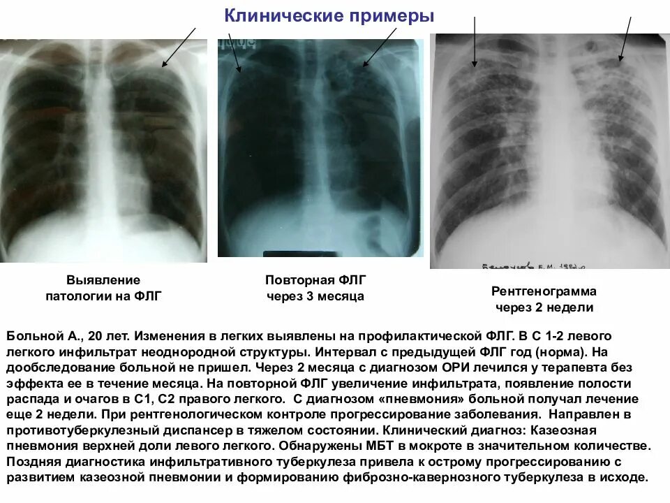 Какие изменения в легких