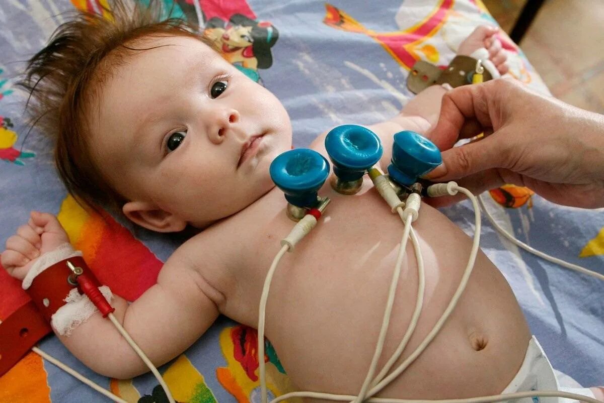 Опн новорожденных. Электрокардиография детей. Детский электрокардиограф.