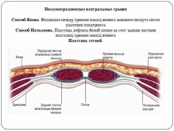 Карта вызова ущемленная грыжа. Послеоперационные грыжи методы операций. Послеоперационные вентральные грыжи • способ Янова.. Методы пластики вентральных грыж. Пластика вентральных грыж виды.