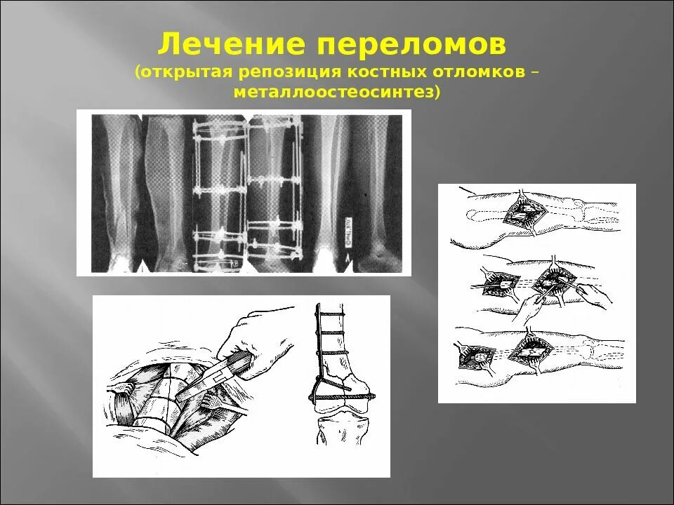 Репозиция кострых отломкла. Репозиция переломов костей. Методы репозиции костных отломков. Открытая репозиция костных отломков.