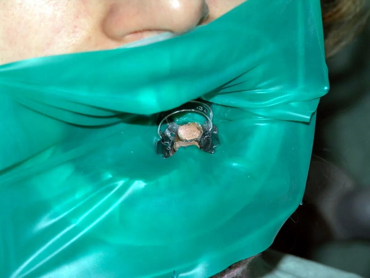 коффердам это в стоматологии