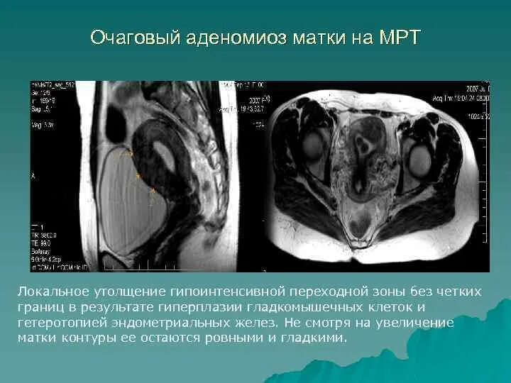 Структурные изменения матки. Аденомиоз и миомы матки на мрт. Очаговый аденомиоз матки мрт. Расширенная полость матки мрт.