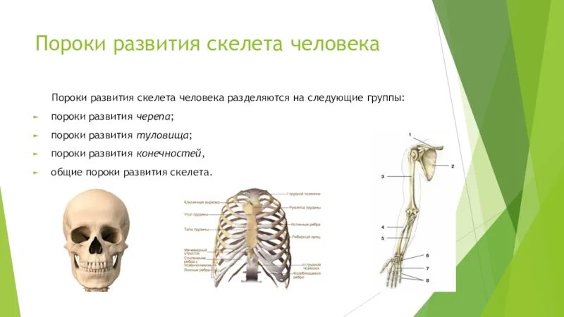 Пороки развития скелета. Пороки развития осевого скелета. Аномалии развития скелета человека. Онтофилогенетические пороки скелета человека. Женщина с нарушением в развитии скелета