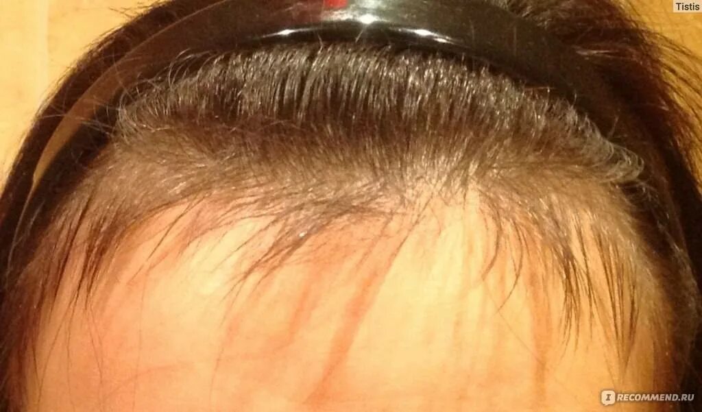 Почему выпадают сильно волосы причина. Послеродовое выпадение волос. Подшерсток на голове у женщин. Подшерсток новых волос на голове.