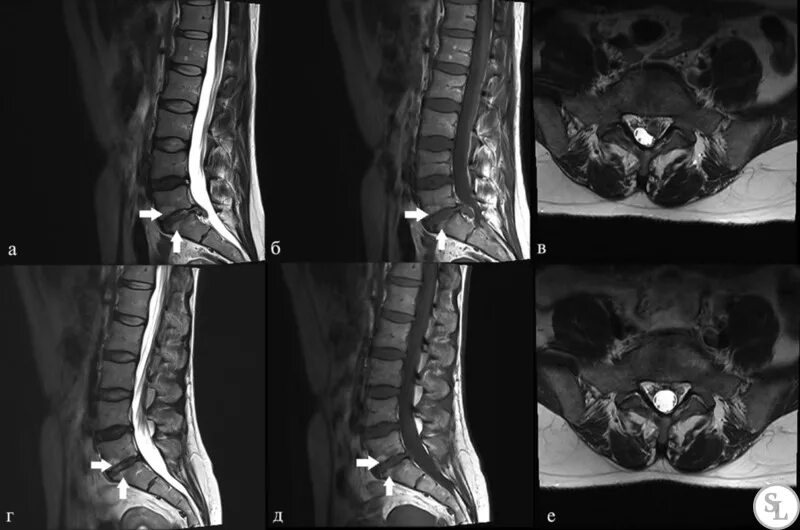 Позвоночник отделы l5 s1. Диск l5-s1. Секвестрированная грыжа l4-s1. Грыжа пояснично-крестцового отдела позвоночника l5-s1 мрт. Задняя протрузия l5-s1.