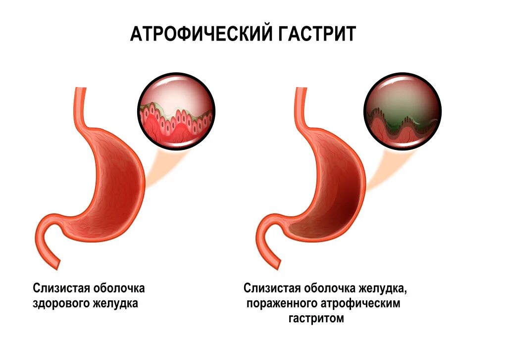 Атрофия слизистой оболочки желудка. Форум атрофическим гастритом желудка