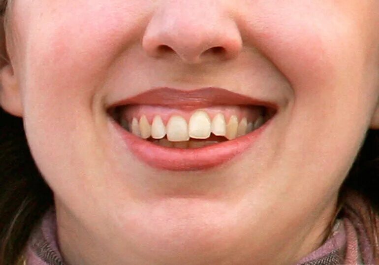 Кривые передние зубы у де. Два зуба кривые. Не ровние передние зубы. Два зуба кривые. Два зуба кривые.