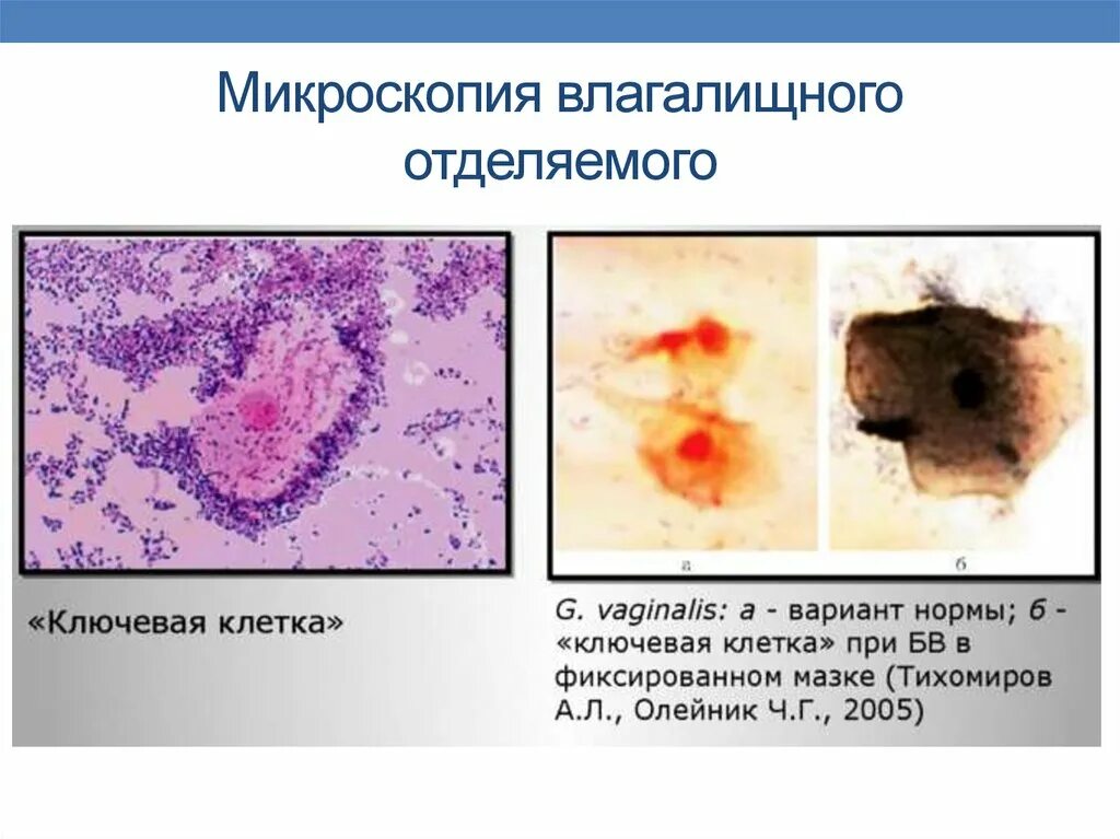 Бактериальный вагиноз мазок микроскопия. Бактериальный вагиноз микроскопия. Ключевые клетки в мазке у женщин что. Ключевые клетки при бактериальном вагинозе. Ключевые клетки в мазке у женщин что.