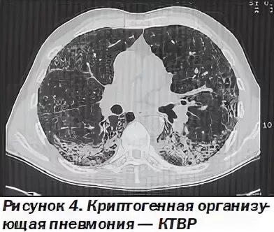Организующаяся пневмония это
