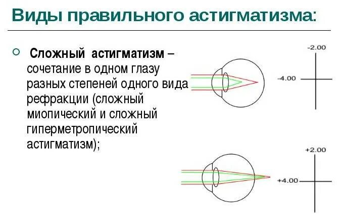 Сложный гиперметропический астигматизм глаз. Сложный гиперметропический астигматизм 2 степени. Сложный миопический астигматизм прямого типа. Сложный гиперметропический астигматизм 1 степени. Сложный прямой гиперметропический астигматизм у детей.