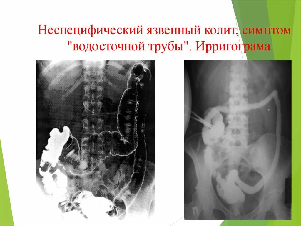 Ирригограмма язвенный колит. Язвенный колит на колоноскопии. Неспецифический язвенный колит симптомы.