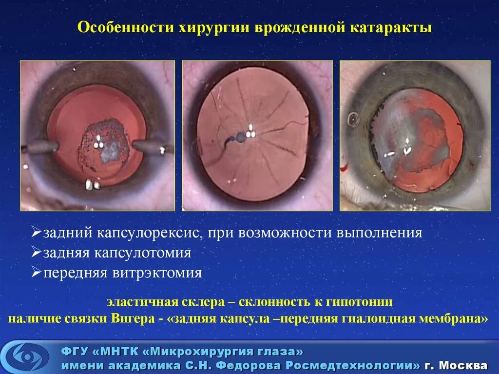 Операция катаракты сколько по времени. Операция проводится при врожденной катаракте. Передний капсулорексис.