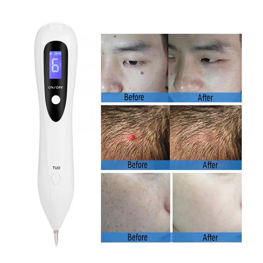 Инструкция point mole beauty pen на русском. Mole removal Pen Beauty start инструкция