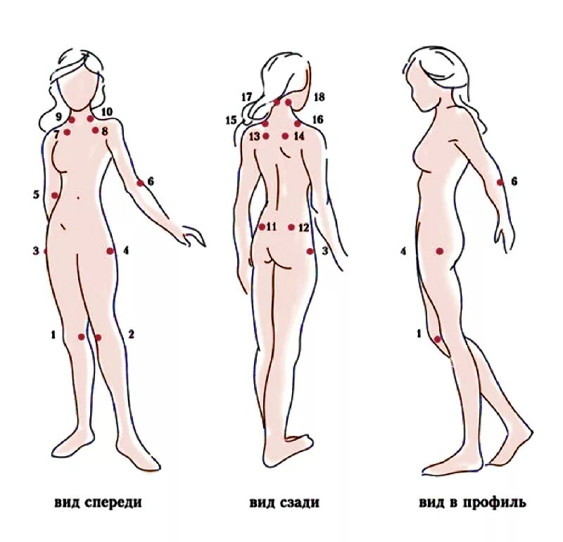 Больные места у человека. Фибромиалгия болевые точки. Триггерные точки при фибромиалгии. Болевые точки на теле при фибромиалгии. 18 Триггерных точек при фибромиалгии.