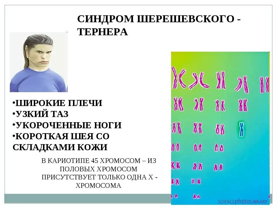 Набор хромосом при синдроме Тернера Шерешевского. Кариотип при синдроме Шерешевского-Тернера. Формула кариотипа при синдроме Шерешевского-Тернера. Кариотип больной Шерешевского Тернера. Болезнь с лишней хромосомой