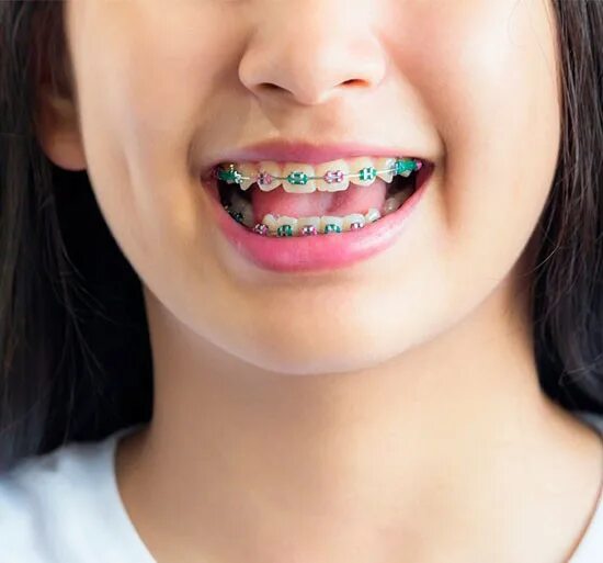 В каком возрасте можно ставить брекеты ребенку. В каком возрасте можно ставить брекеты ребенку. В каком возрасте можно ставить брекеты ребенку. В каком возрасте можно ставить брекеты ребенку. В каком возрасте можно ставить брекеты ребенку.