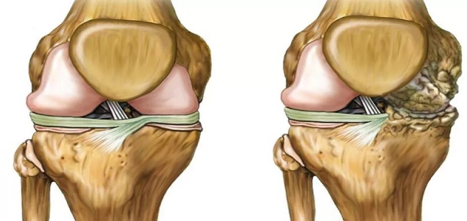 Изменения в коленных суставах. Остеоартрит коленного сустава. Артроз коленных суставов (гонартроз). Деформирующий остеоартроз коленного сустава.
