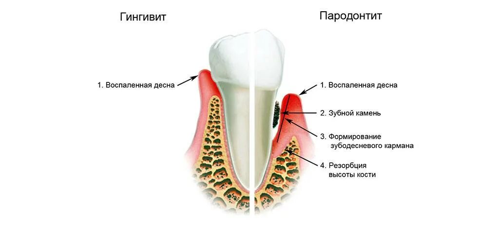 Заболевания зубов и десен. Воспаление зубов и десен.
