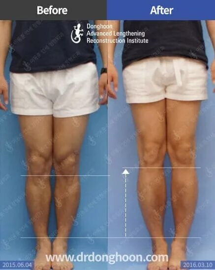 операция по увеличению роста. увеличение роста новые технологии. увеличение роста новые технологии. увеличение роста новые технологии. увеличение роста новые технологии.