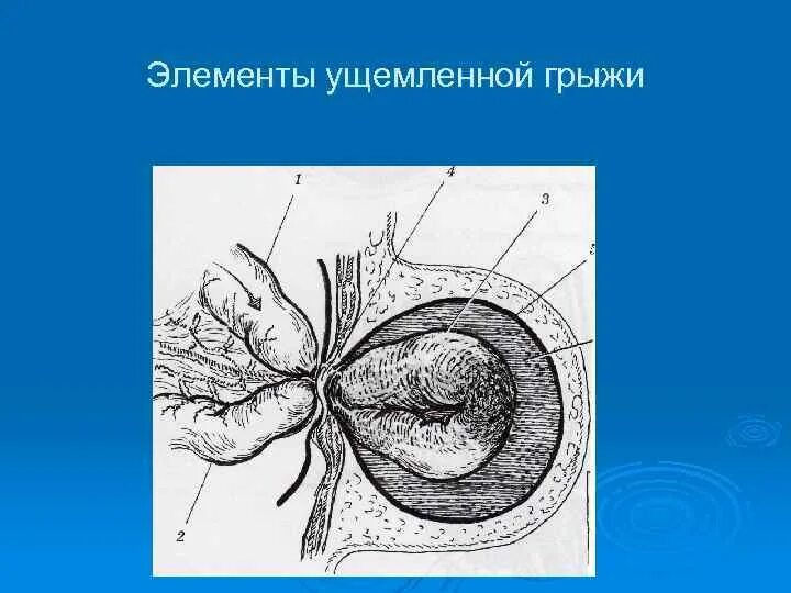 Ответы ущемленная грыжа. Ущемление вентральной грыжи. Элементы ущемленной грыжи. Ущемленные наружные грыжи. Грыжи брюшной стенки (ущемление).