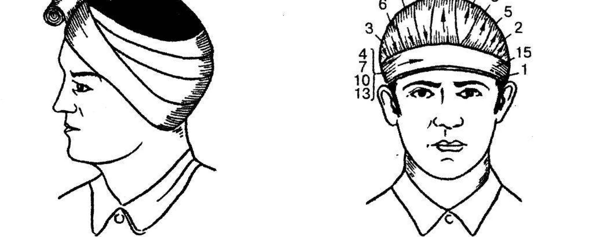 Чепец повязка на голову алгоритм. Повязка на голову при травме чепец. Перевязка головы бинтом чепец. Схема наложения повязки чепец. Как перевязывать голову