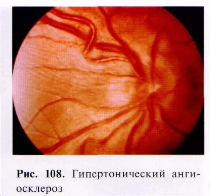 Болезнь глазного дна. Гипертонический ангиосклероз сетчатки. Ангиопатия сосудов сетчатки глаза. Гипертоническая ангиопатия и ретинопатия. Гипертензивная ретинопатия.