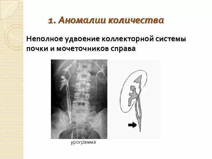 Удвоение мочеточника. Неполное удвоение почки рентген. Неполное удвоение ЧЛС почки на рентгене. Неполное удвоение почки урография. УЗИ признаки неполного удвоения почки.