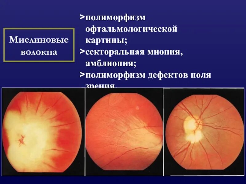 Миелиновые нервные волокна глазное дно. Миелиновые волокна ДЗН. Миелиновые волокна диска зрительного нерва. Врожденная аномалия диска зрительного нерва миелиновые волокна.