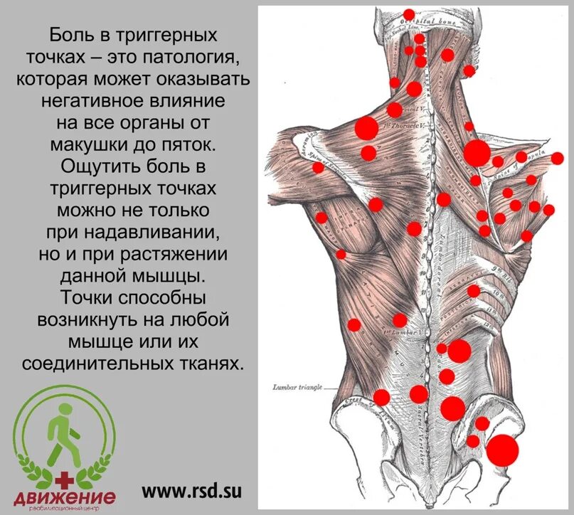 Триггерные точки это простыми словами. Карта триггерных точек. Массаж триггерных точек. Карта триггерных точек спины. Триггерные точки схема.