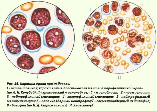 Хронический лейкоз кровь