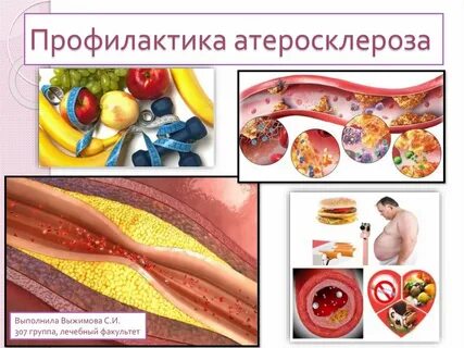 Профилактика атеросклероза