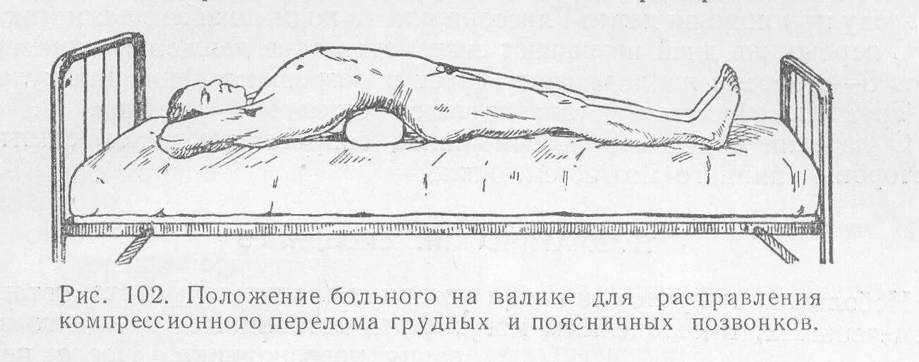Положение больного при компрессионном переломе позвоночника. Положение при компрессионном переломе позвоночника. Неосложненный компрессионный перелом. Положение при переломе поясничного отдела позвоночника.