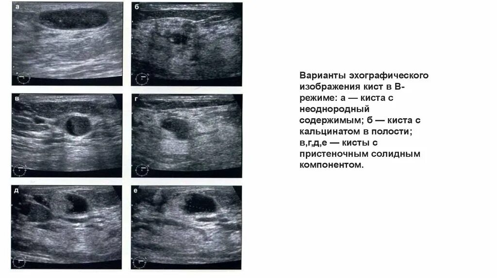 Очаговая фиброзно кистозная мастопатия УЗИ. Киста с кальцинатом в молочной железе на УЗИ. Кистозно-Солидное образование яичника УЗИ.