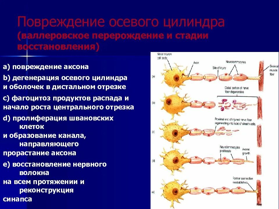 Повреждение периферических нервов. Дегенерация и регенерация нервных волокон. Регенерация аксона. Дегенерация и регенерация периферического нерва. Регенерация нервной ткани.