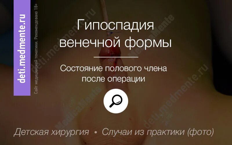 Гипоспадия после операции - Арт Минск.ру