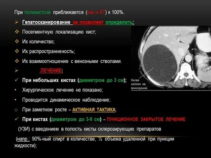 Киста левой доли печени