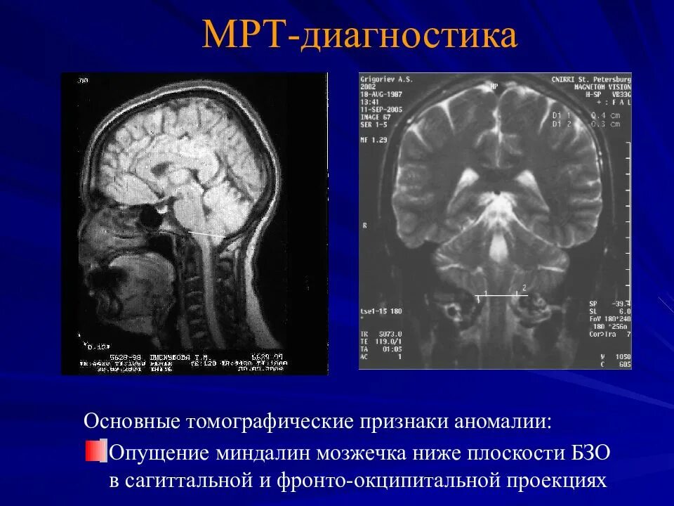 Пролабирование мозжечка. Опущение миндалин мозжечка мрт. опущение миндалин мозжечка в большое затылочное отверстие. дислокация миндалин мозжечка. пролабация миндалин мозжечка.