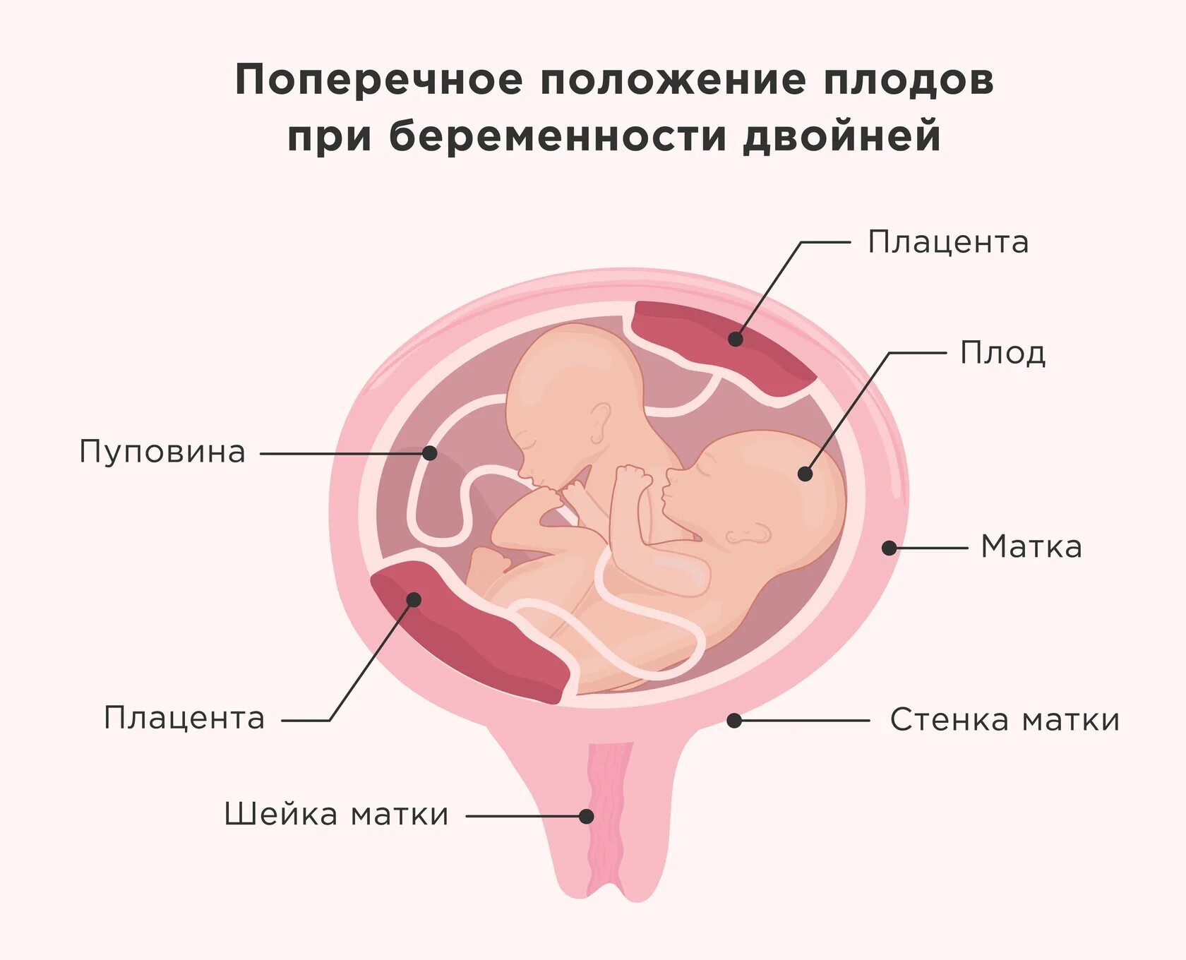 Положение плода продольное головное. Поперечное положение плода. Положение плода при беременности. Поперечное предлежание плода. Положение плода в матке продольное