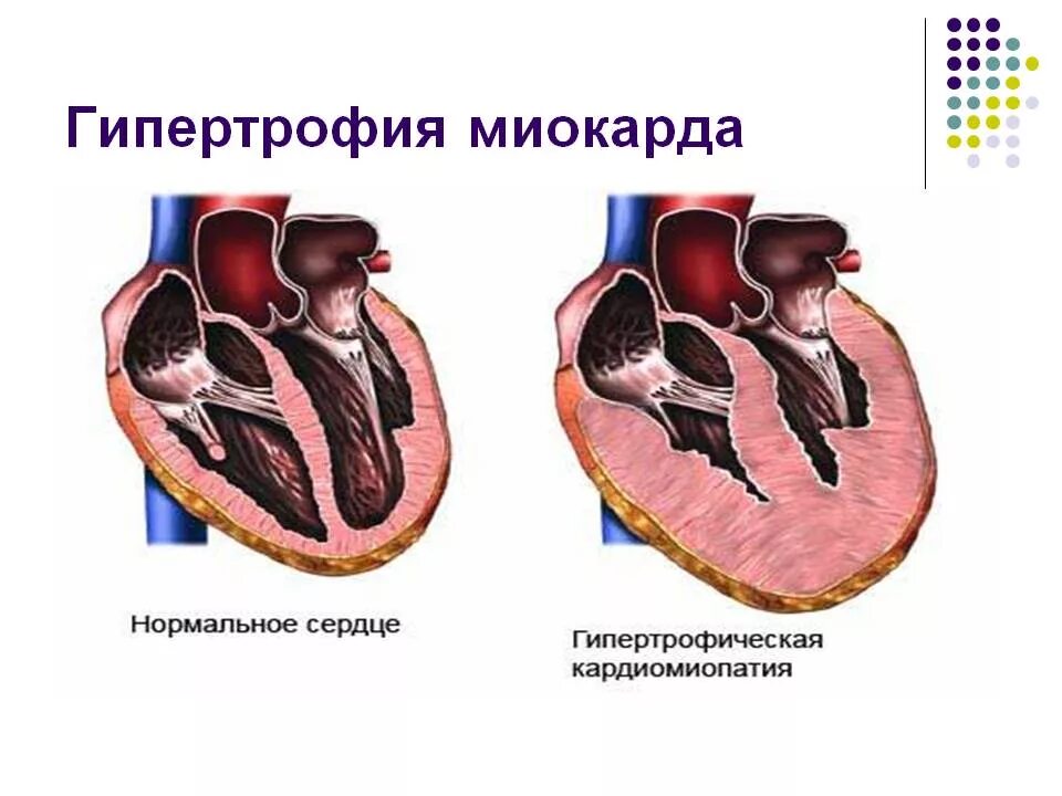 Гипертрофия полостей сердца. Гипертрофия и дилатация миокарда. компенсаторная гипертрофия левого желудочка.