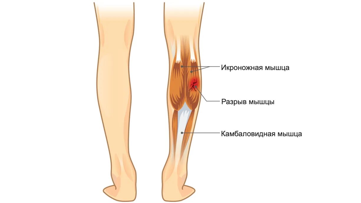 Разрыв икроножной мышцы. Микронадрыв икроножной мышцы. Надрыв икроножной мышцы.