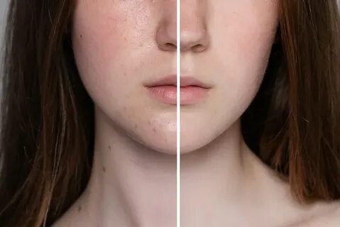 skin pigmentation treatment