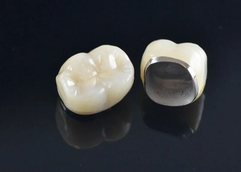 Сколько будет стоить коронка на зуб. Металл керамика коронка. Временные коронки из пластмассы. Как устанавливается коронка. Стоматологические коронки.