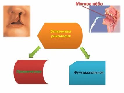 Открытая ринофония