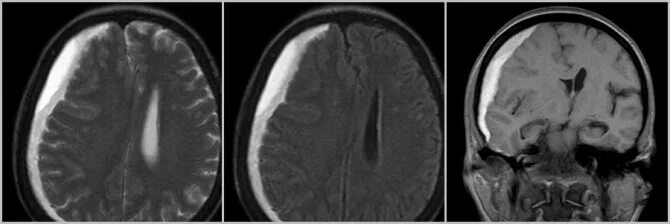 Черепно мозговые гематомы. Субдуральная гематома мрт. Субдуральное кровоизлияние кт. Субдуральная гематома головного мозга мрт. Внутримозговая гематома кт.
