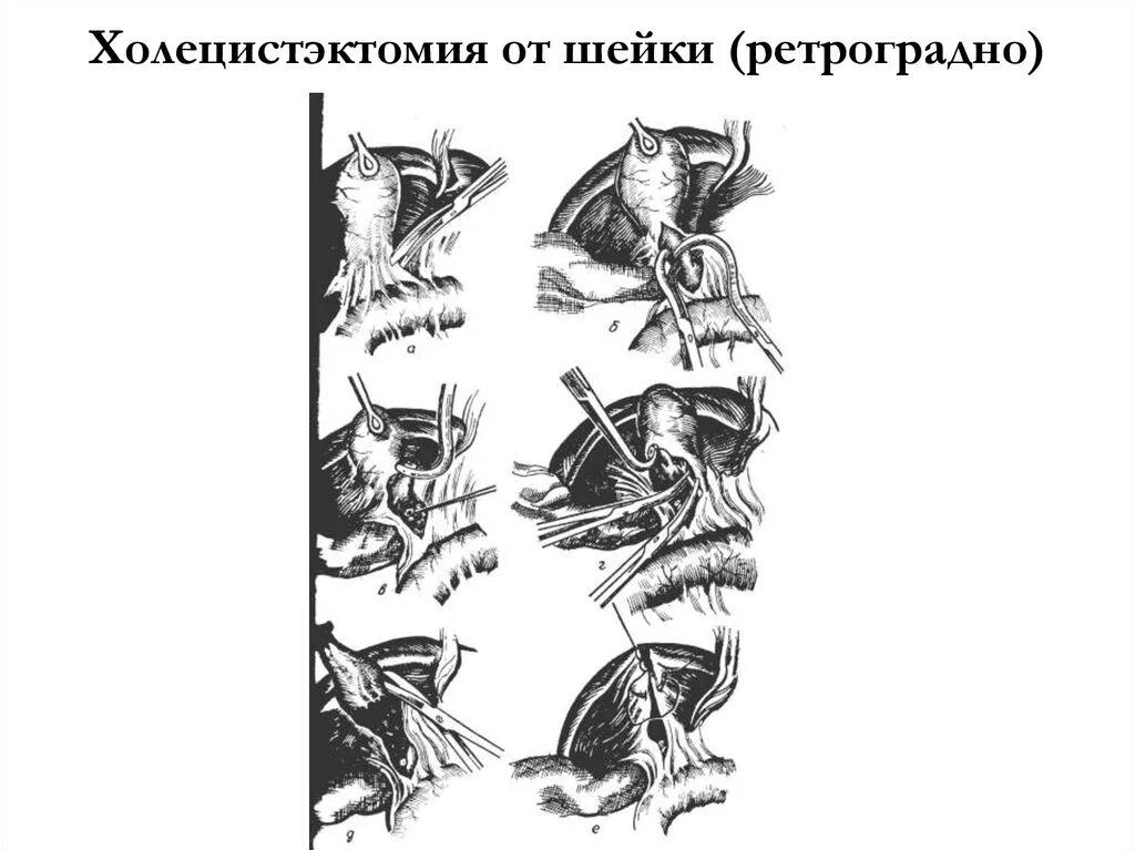Виды холецистэктомии. Этапы холецистэктомии от шейки. антеградная и ретроградная холецистэктомия.