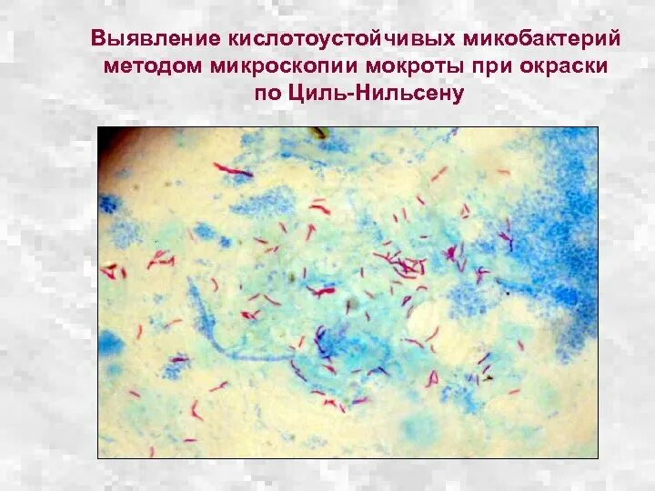 Анализ мокроты на микобактерии. Окраска кислотоустойчивых микобактерий по Цилю-Нильсену. Исследование мокроты по Цилю-Нильсену. Окраска мокроты по Цилю-Нильсену. Микобактерии Циль Нильсен.